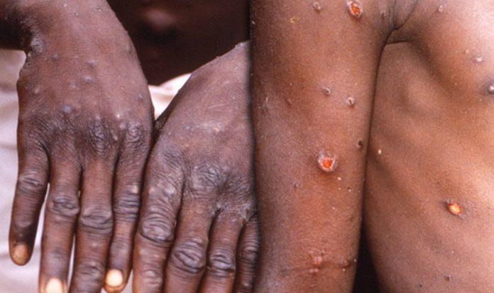 Monkeypox disease recorded in Ghana - GHS